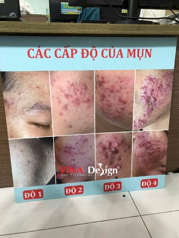 In trên Formex ảnh Các cấp độ của mụn Độ 1 Độ 2 Độ 3 Độ 4 ốp tường spa chăm sóc da mụn - VND733